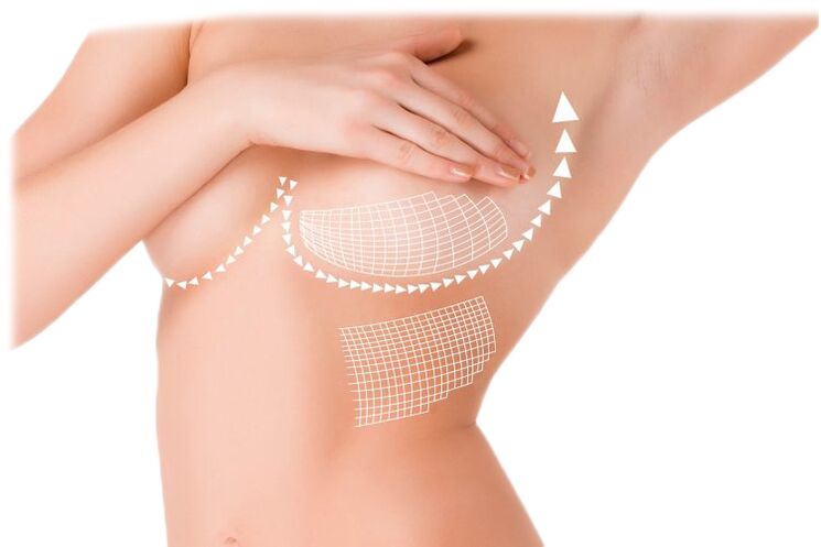 Action of Mammax breast augmentation capsules
