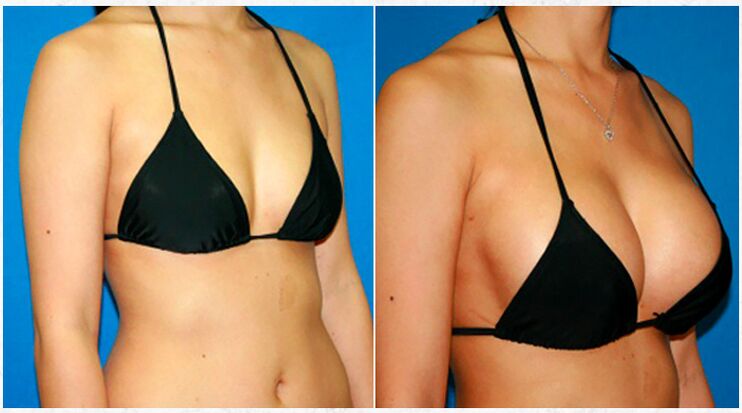 Before and after breast augmentation plastic surgery