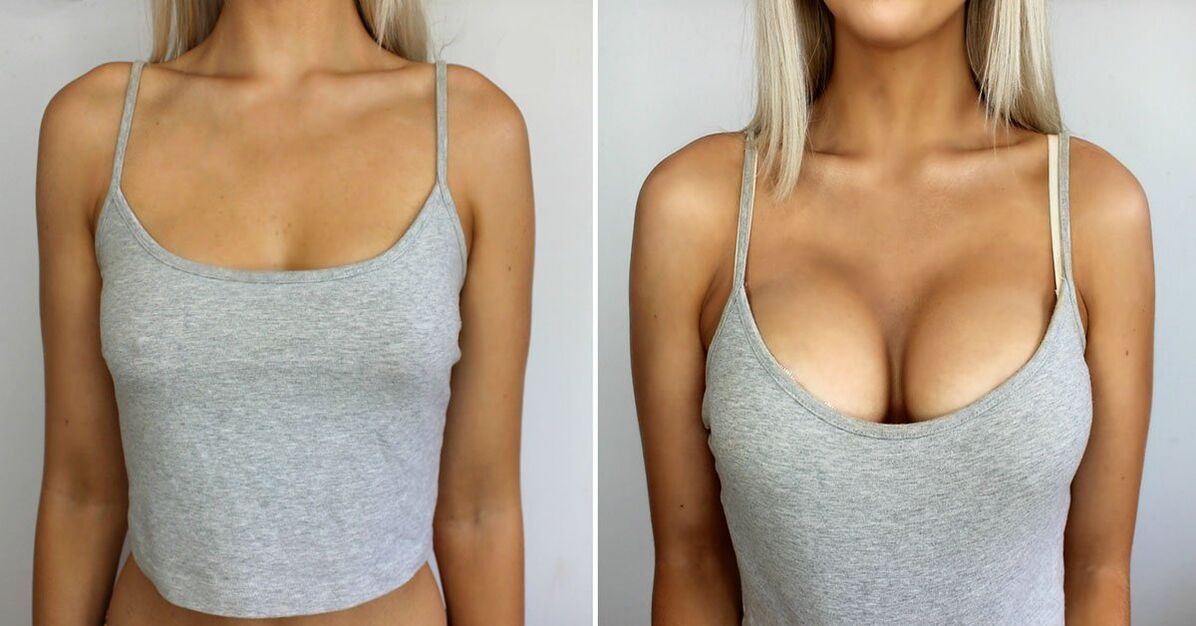 Before and after breast enlargement